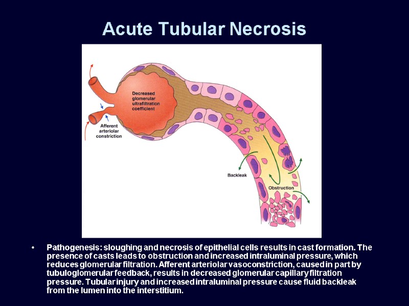 Acute Tubular Necrosis Pathogenesis: sloughing and necrosis of epithelial cells results in cast formation.